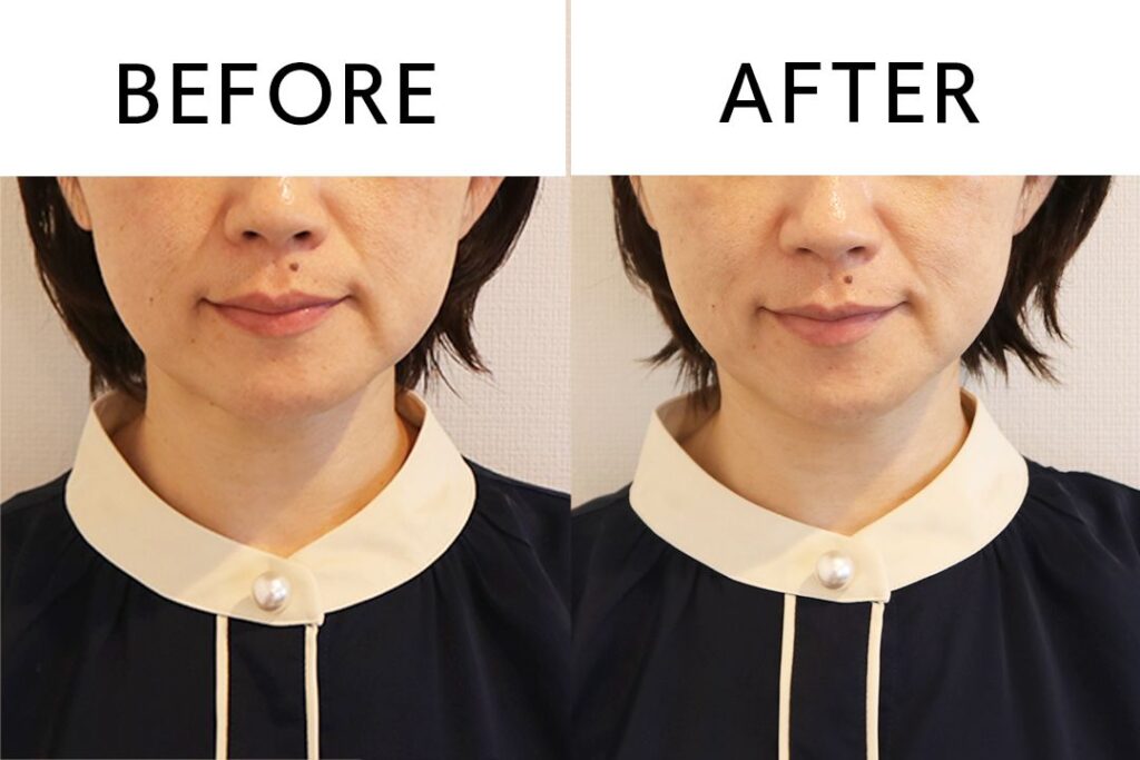 小顔矯正nicori_before/after